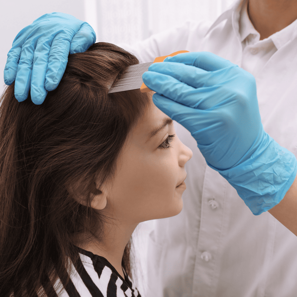 head-lice-